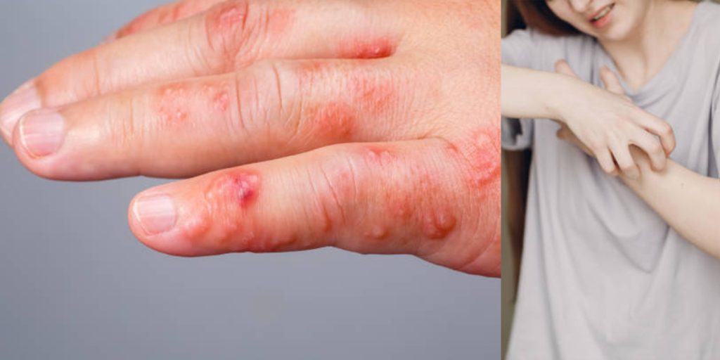 চুলকানি ও খোসপাচরার ভয়াবহ প্রাদুর্ভাব: কুমিল্লা ও চট্টগ্রামে বাড়ছে রোগীর সংখ্যা